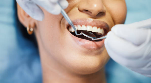 Best Emergency Wisdom Teeth Removal in Palmetto, GA